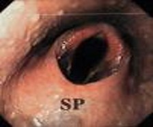 Dorsal displacement of the soft palate (DDSP)