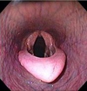 Epiglottic entrapment