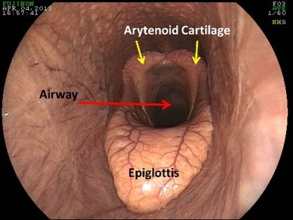 Normal equine airway structure during rest.