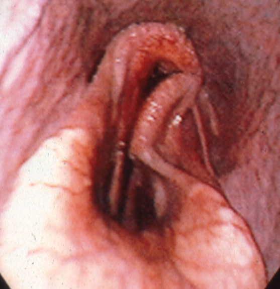 Laryngeal hemiplegia (roaring)